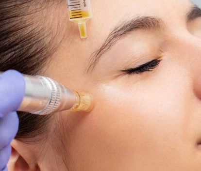 Microneedling